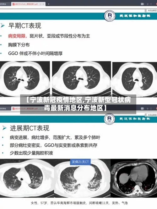【宁波新冠疫情地区,宁波新型冠状病毒最新消息分布地区】-第1张图片